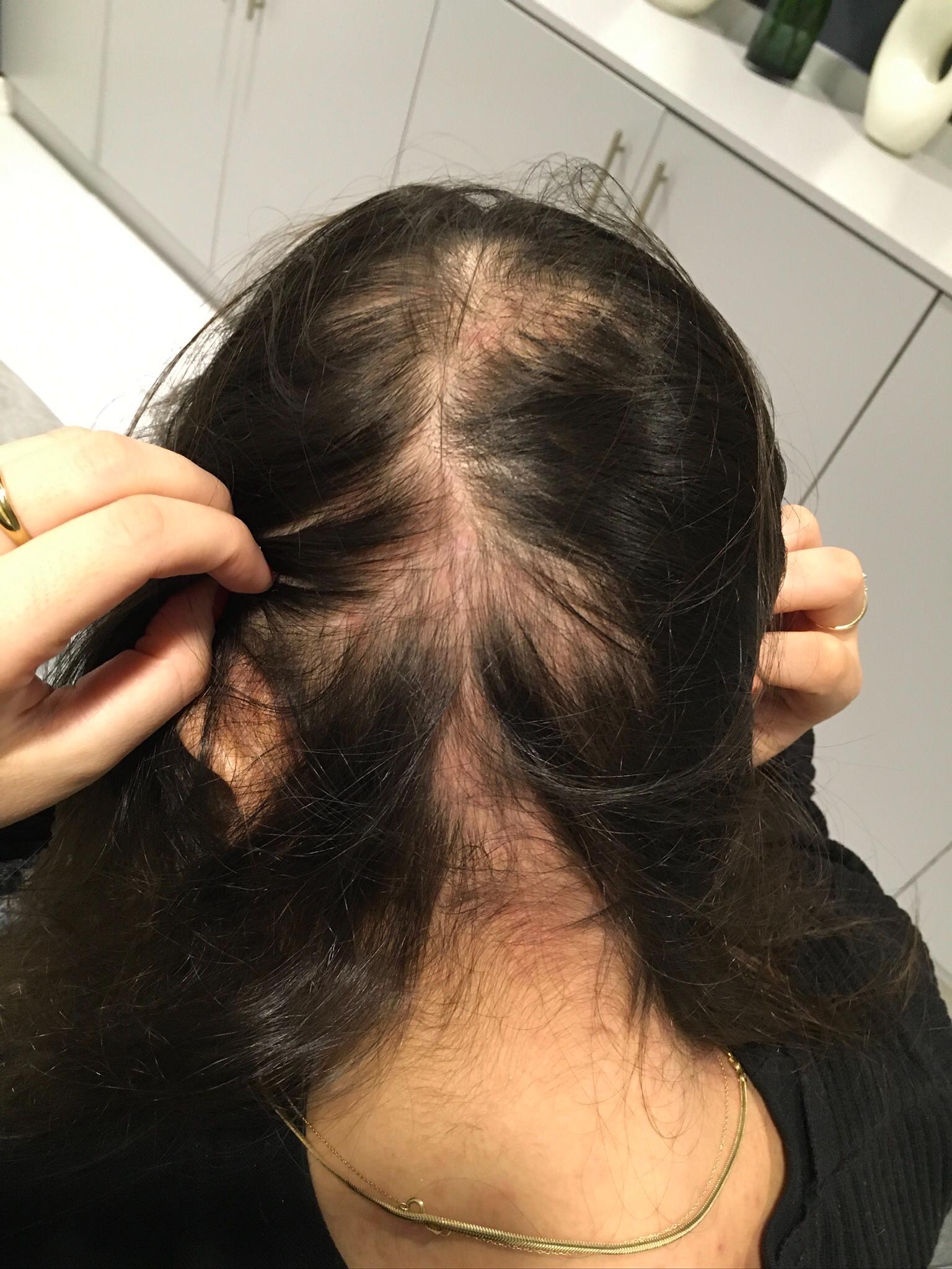 Saç Çoğaltma – 6 Ay - Önce